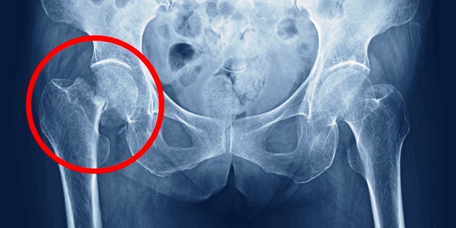 fractura de cadera rayos x