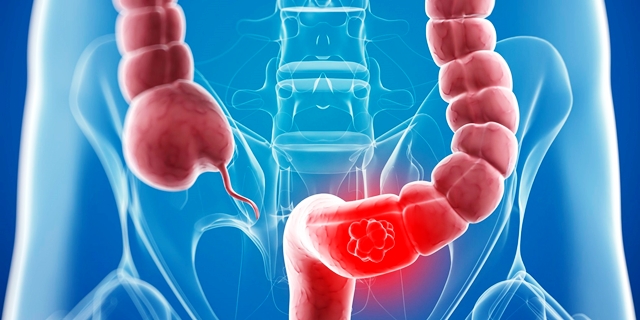 cómo evitar el cáncer de colon con una buena alimentación